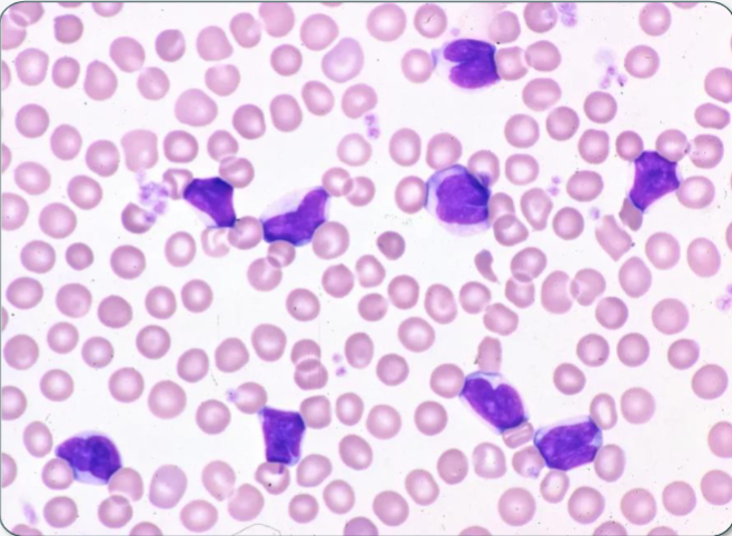 <p>What lymphocytotic pathogen/disease causes this immune response? What is the cause of this absolute lymphocytosis?</p>