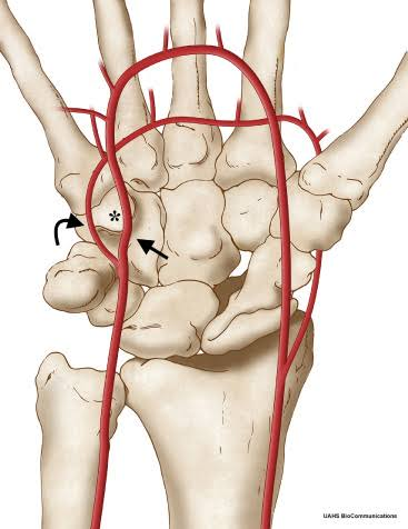 <p>Hypothenar Hammer Syndrome</p>