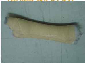 <p>fracture<span> </span>of<span> </span>the<span> </span>first<span> metacarpal BONE</span></p>