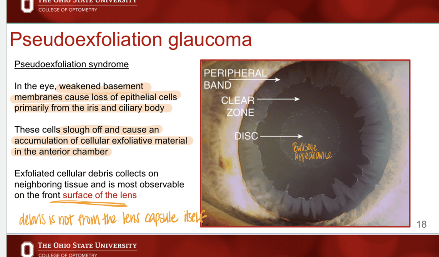 <p>What is the effect of pseudoexfoliation syndrome in the eye?</p>