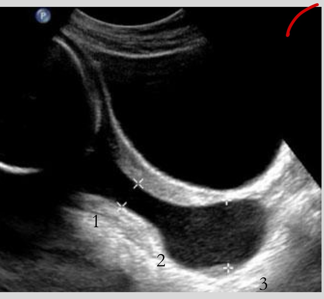 <p>What is seen in severe cervical incompetence</p>