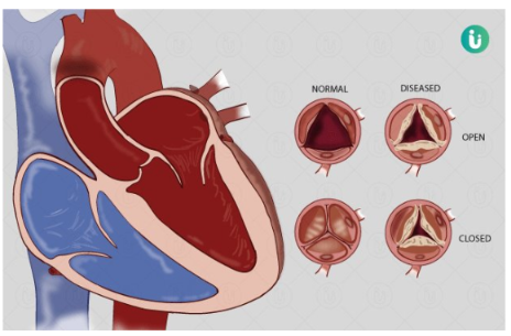 <p>What is Rheumatic Heart Disease?</p>