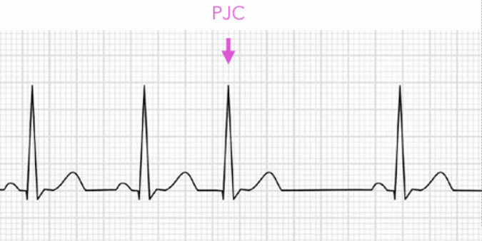 <p>If the AV node’s rate of automaticity is faster than the sinus rate, the AV junction will then be the site of activation, and the signals travels backward (retrograde) to the atria</p>