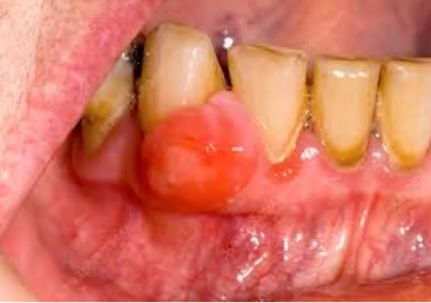 <p>30 y/o woman, firm, pink mass on interdental papilla in anterior mandible, all the following are in the differential diagnosis EXCEPT: </p><p>peripheral giant cell granuloma </p><p>pyogenic granuloma </p><p>irritation fibroma </p><p>peripheral ossifying fibroma </p>