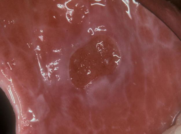 <p>• Lichenoid lesions of palate, buccal mucosa, or gingiva</p><p>• May involve vermilion (lupus cheilitis)</p><p>• Ulceration, pain, erythema, and hyperkeratosis seen in varying degrees</p>