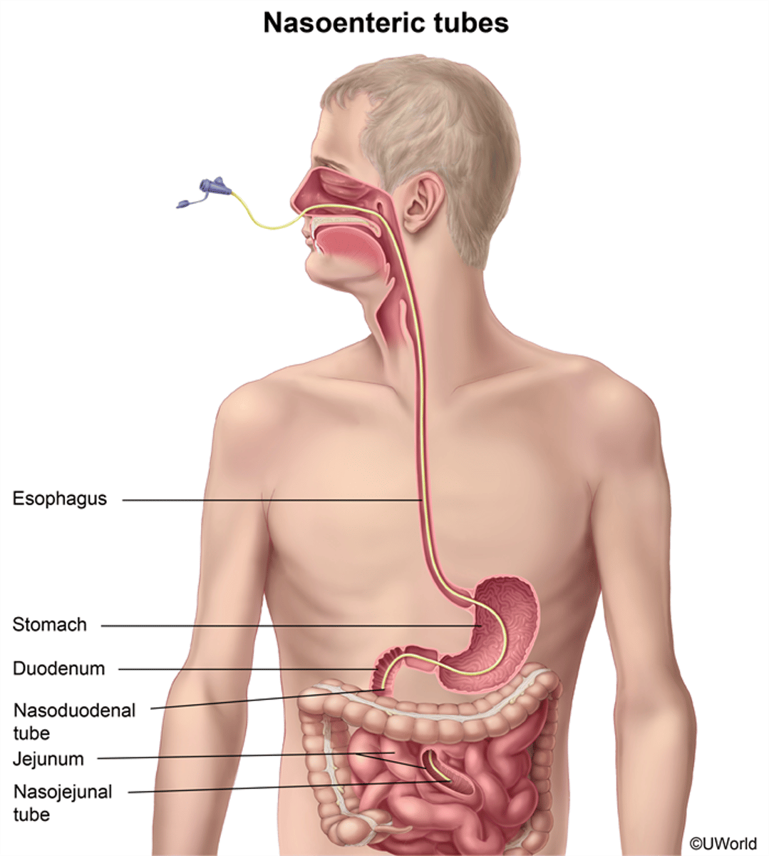 <p>feeding tube is inserted through the nose into the small bowel</p>