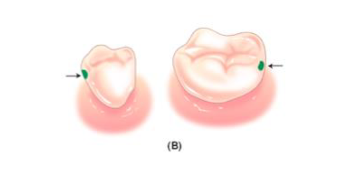<p>Proximal( mesial or distal) surfaces of posterior teeth. Commonly involves occlusal surface, molars and premolars.</p>