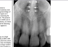 <p>Radiopaque vertical line dividing the nasal cavity</p>