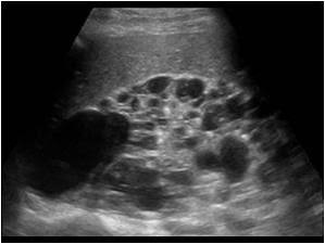 <ul><li><p>bilateral </p></li><li><p>enlarged kidneys with multiple macroscopic asymmetrical cysts </p></li></ul><p></p>