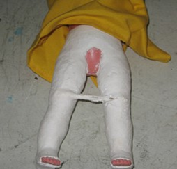 <p><span>hip and femur affection</span></p>