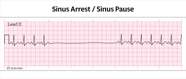 <p>A type of <strong>Bradyarrythmia</strong></p><ul><li><p><span>SA node fails to fire then resumes or a</span><br><span>different pacemaker fires</span></p></li></ul><p></p>