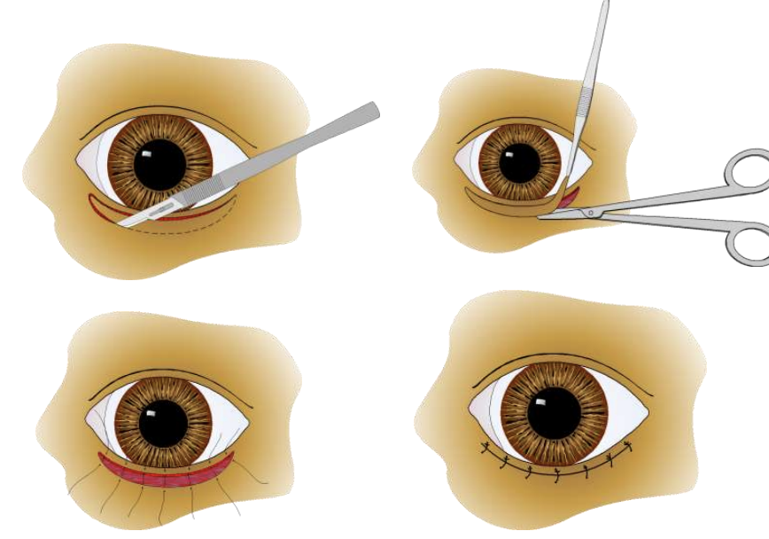<p>A modification of what procedure is the main permanent surgical treatment for entropion? It is often combined with wedge resection and lateral canthal closure.</p>