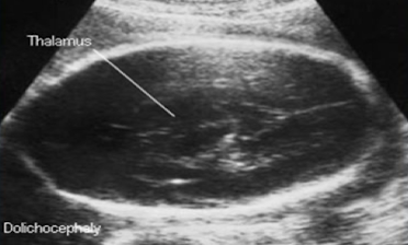 <p>narrow BPD and long occipitofrontal diameter (OFD)</p>