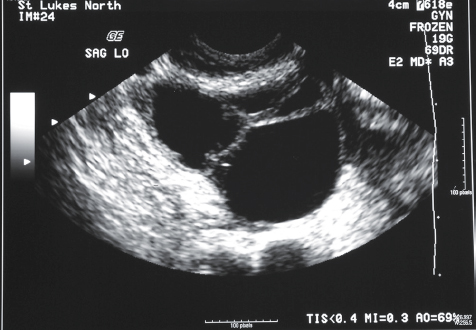 <p>11. The patient in Figure 21-27 is also suffering from electrolyte imbalance, oliguria, and nausea. The patient also has ascites. What other sonographic finding is most likely present?</p><p>a. Pleural effusion</p><p>b. Hepatic periportal cuffing</p><p>c. Pancreatic enlargement</p><p>d. Subhepatic adhesions</p>