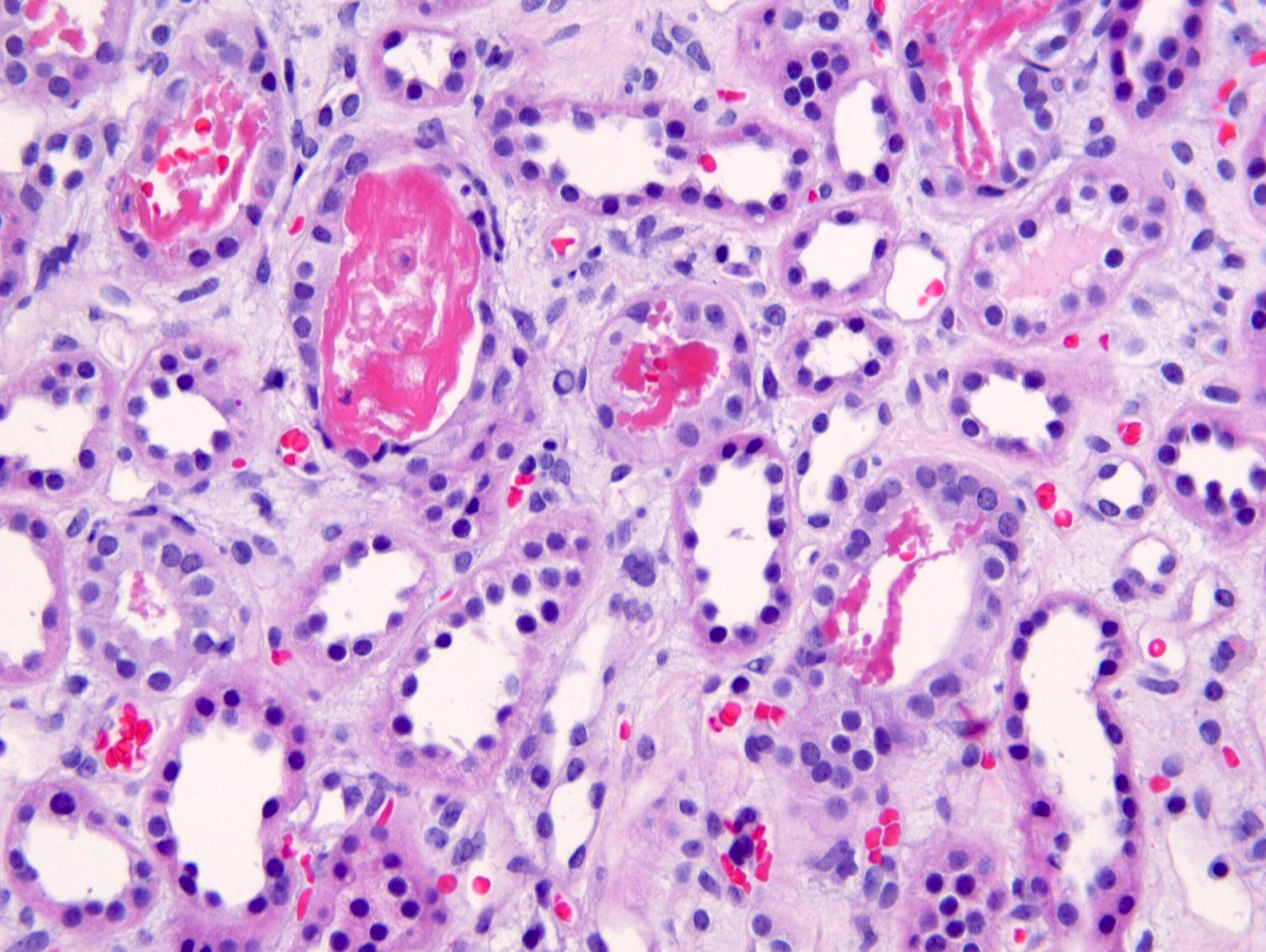 <p>RHABDOMYOLYSIS</p>