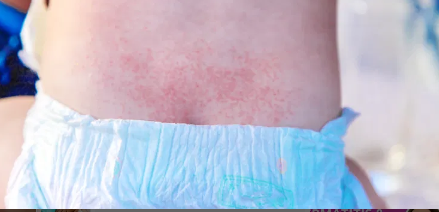 <p>causes:</p><ol><li><p><span style="color: rgb(180, 130, 18);"><strong>urine/feces</strong></span> friction</p></li><li><p><span style="color: rgb(106, 87, 208);"><strong>irritants</strong></span>: detergents</p></li><li><p><span style="color: rgb(242, 107, 107);"><strong>candida albicans</strong></span> (yeast infections)</p></li></ol><ul><li><p>long term use of abx</p></li></ul><p>tx:</p><ol><li><p><span style="color: rgb(38, 157, 92);"><strong>zinc oxide</strong></span> (barrier)</p></li><li><p><span style="color: rgb(204, 27, 164);"><strong>antifungals </strong></span>(nystatin, clotrimazole)</p></li><li><p><span style="color: rgb(177, 155, 49);"><strong>severe</strong></span>→ hydrocortisone</p></li></ol><p></p>