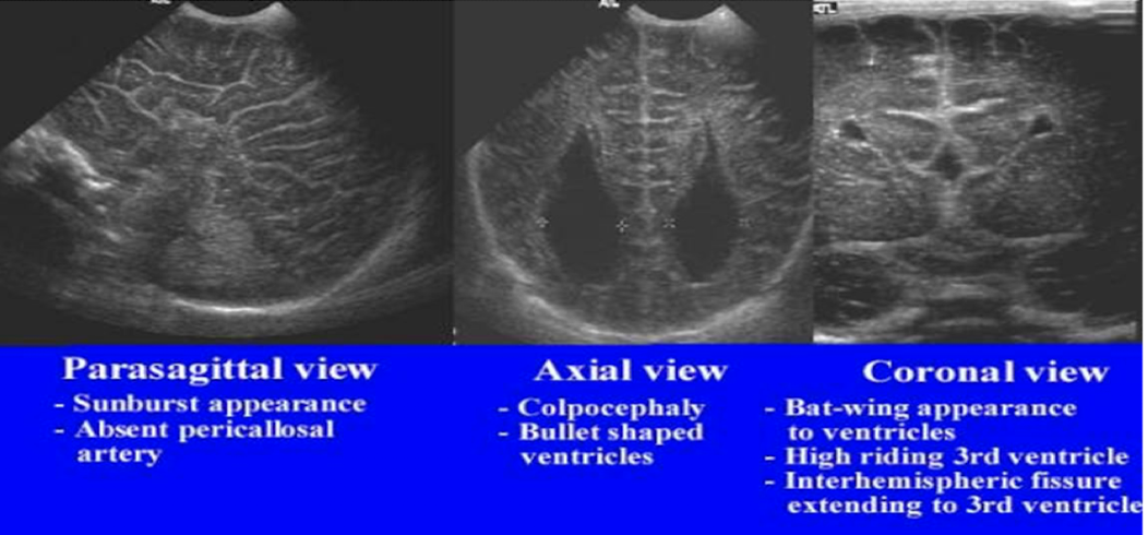 <ul><li><p>absence of CSP </p></li><li><p>colpocephaly (disproportionate prominence of occipital horns of lateral ventricles) bullet shaped</p></li><li><p>sunburst appearance </p></li></ul><p></p>
