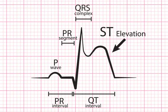 <p>STEMI is a complete blockage of a major coronary artery, whereas an N stemi is an incomplete (partial) blockage of a major coronary artery. </p>