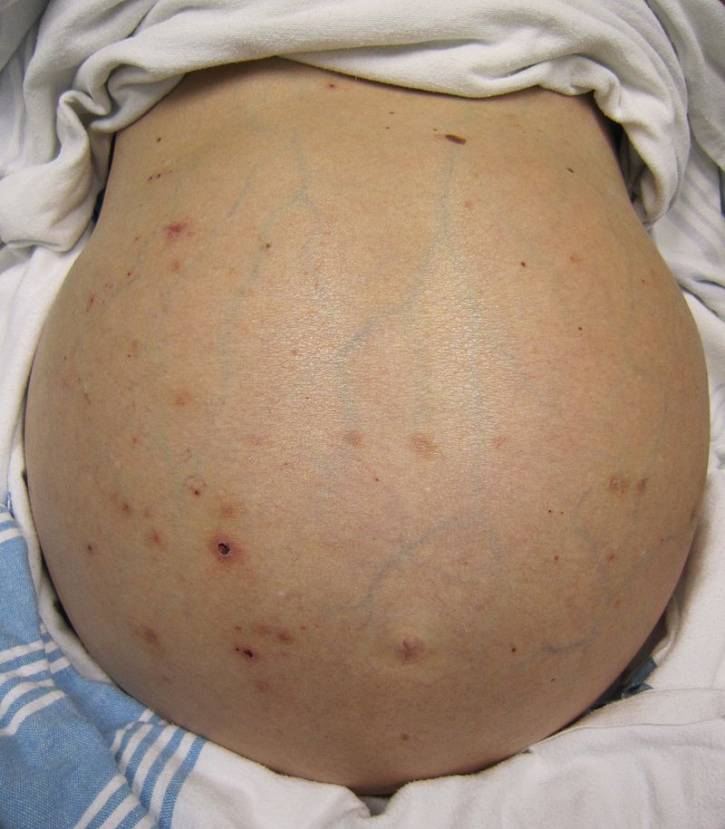 <p>abdominal distention</p>