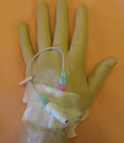 <p>• When continuous infusion of solutions or medications is not necessary, a short-peripheral IV can be locked with preservative-free 0.9% sodium chloride (NS).</p><p class="p1">• The “old” term is HepLock</p><p class="p2"><em>WHY?</em></p><p class="p2"><em>Thinking Nurse: What gauge is the PIV on the photo?</em></p>