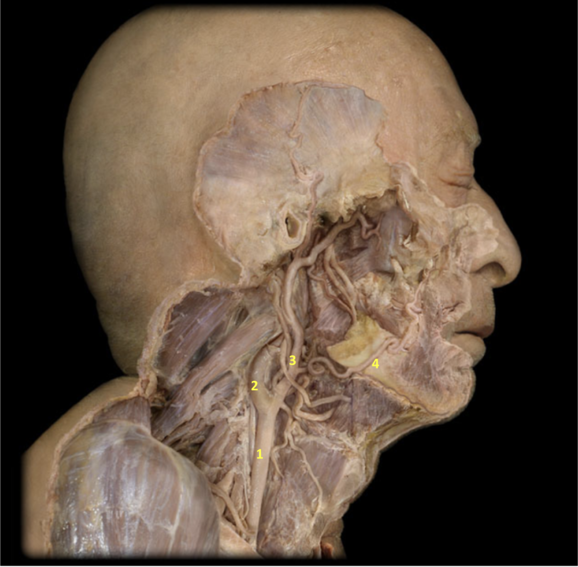 <p>Lateral Neck and Face - Deeper Dissection</p><p>1. Right common carotid artery</p><p>2. Right internal carotid artery </p><p>3. Right external carotid artery</p><p>4. Right facial artery</p><p></p>