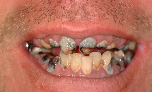 <p>radiation therapy induced</p>