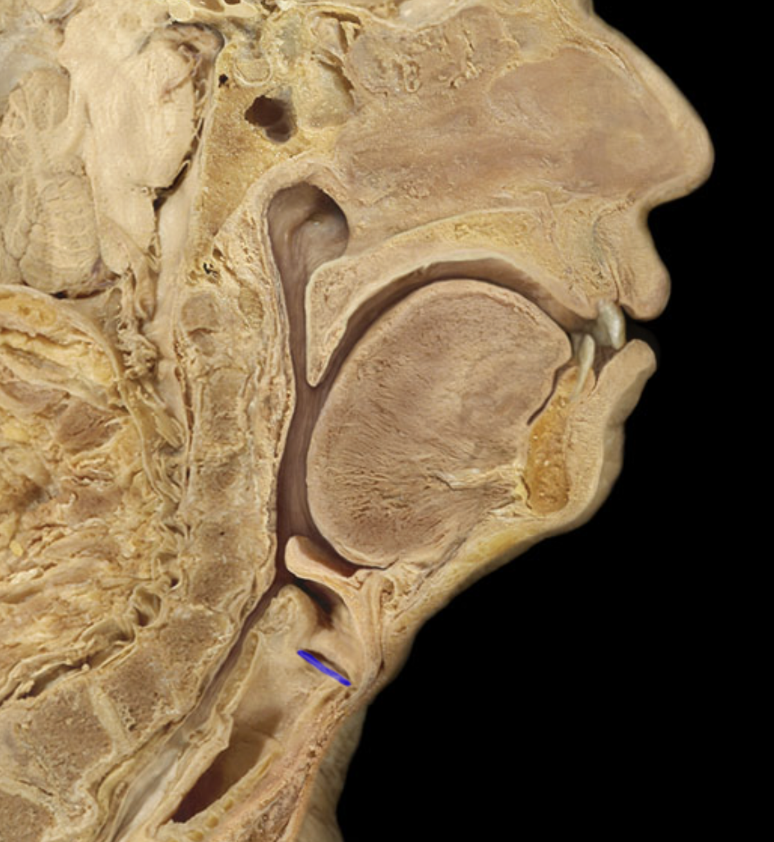 <p>True vocal folds - makes noise </p>