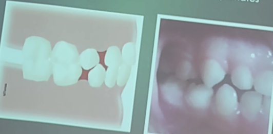 <p><span style="background-color: transparent;">Espacios localizados por distal de caninos temporales inferiores y mesial de los superiores, llamados “primates”</span></p>