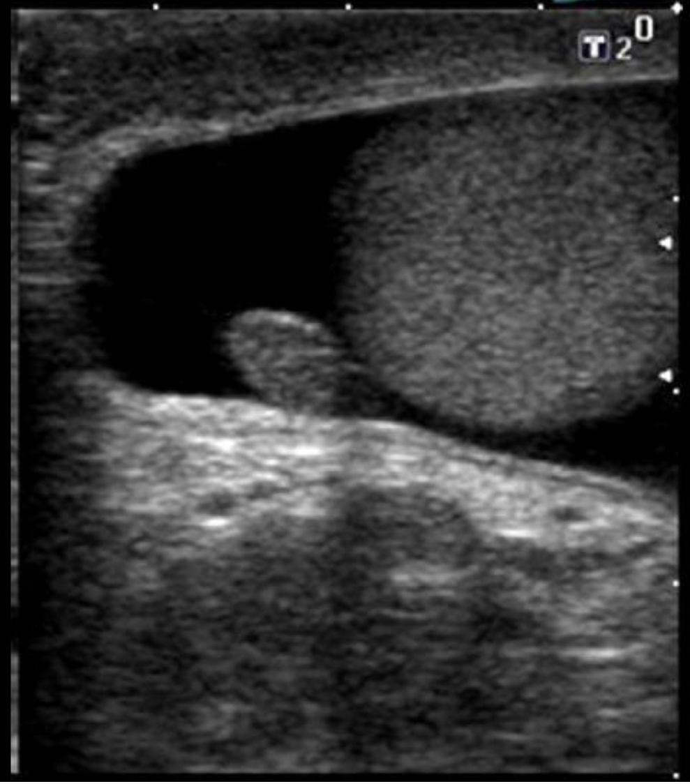 <p>Which of the following correctly describes the findings on the image?</p><p>A. There is loculated hydrocele present.</p><p class="p1">B. There is an extratesticular mass present.</p><p class="p1">C. There is an appendix teste present</p><p class="p1">D. There is a scrotal pearl present.</p>