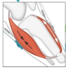 <p>agonist-antagonist myoneural interface (AMI) </p>