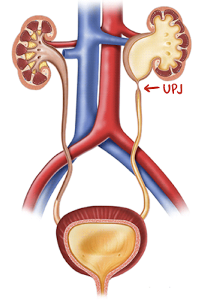 <ul><li><p>obstruction at the junction b/w renal pelvis and ureter</p></li><li><p>MC location for renal obstruction</p></li><li><p><span style="color: red;">MC cause of hydro in neonate</span></p></li><li><p>considered congenital hydronephrosis</p></li><li><p>MC male</p></li><li><p>usually unilateral</p></li></ul><p></p>