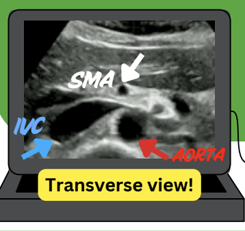 <p>Post-prandially what happens to the SMA, what is the criteria for a SMA stenosis </p>