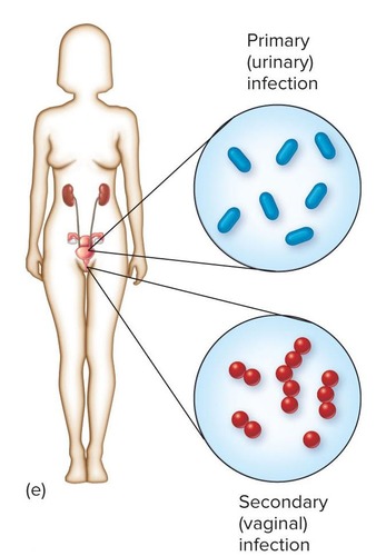 <p>Primary infection is the initial infection. Secondary infection occurs when a primary infection is complicated by another infection caused by a different microbe.</p>