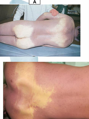 <p>Case</p><p></p><div data-type="horizontalRule"><hr></div><p>Questions</p><ol><li><p>What postmortem change is described by the confluent reddish-purple discoloration on the back?</p></li><li><p>What causes the contact flattening (contact pallor) observed over the scapula and buttocks?</p></li></ol><p></p><p></p>