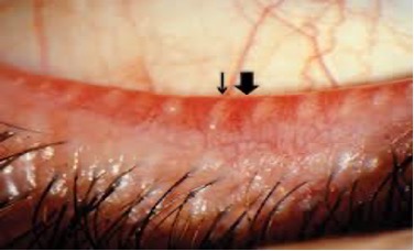 <p><span>Tarsal glands</span></p>