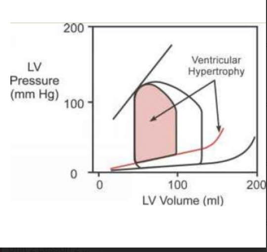 <p><strong>EDV decreases</strong>.</p><p><strong>Simple reminder:</strong><br>The LV is stiff, so it fills with less blood / reduce filling and pressure rises faster</p>