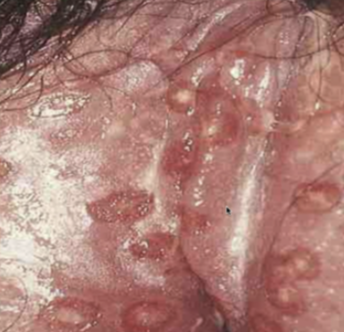 <p>⚠️‼️(#17,#32)37.Identify the lesion: A.Granuloma inguinale B.Lymphogranuloma venereum C.Syphilis D.Herpes simplex</p>