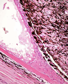 <p>From inflammation</p><ul><li><p>Preiridial fibrovascular membrane (PIFM)</p></li></ul><img src="https://assets.knowt.com/user-attachments/55265a13-91ec-4601-bc24-7298f92db9e8.png" data-width="100%" data-align="center"><p></p>