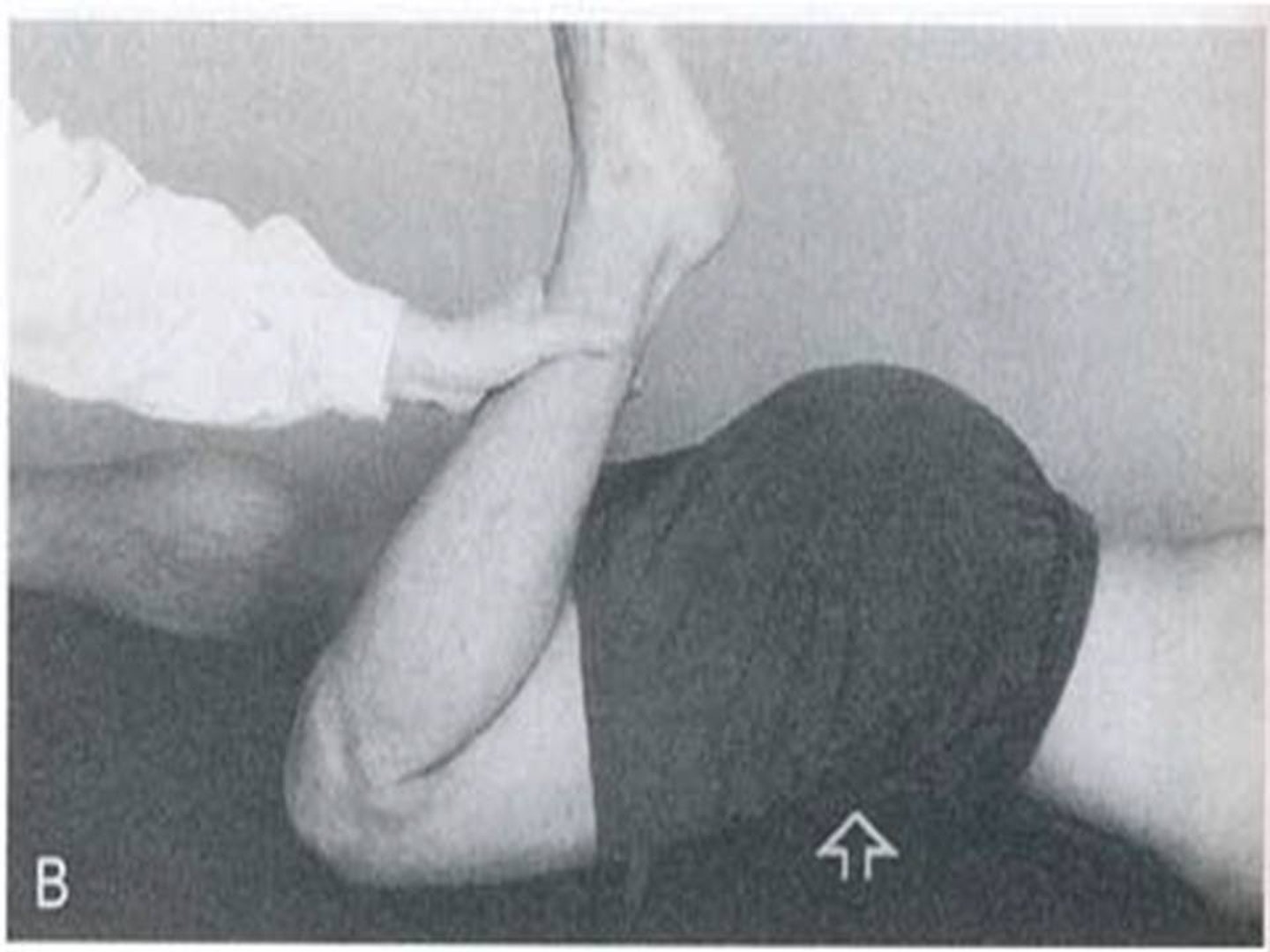 <p>Tightness of rectus femoris</p>