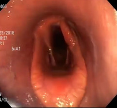 <p>What is your diagnosis:</p><p>a. left laryngeal hemiplegia</p><p>b. right laryngeal hemiplegia</p><p>c. dorsal displacement of the soft palate</p><p>d. pharyngeal collapse</p>