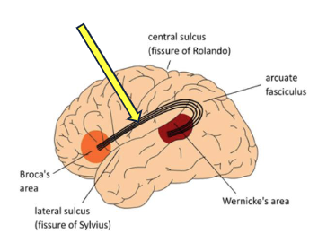 <p><span> Impaired repetition of speech<br> Also inability to produce appropriate responses to heard communication (even though the communication is understood</span></p>