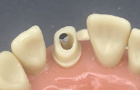 <p>You must modify the temporary post length at its apical end so that only 2-3mm of the retentive portion extends out of the canal orifice </p>