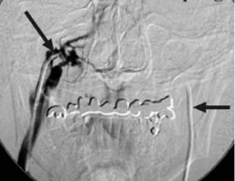 <p><span>gold standard for determining the source of ACTH production</span></p>