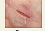 <p>What is the type of lesion and how is it defined?</p>