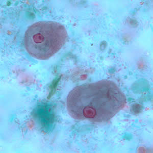 <p>1 nucleus w/eccentric/large karyosome</p><p>Dirty/vacuolated cytoplasm</p><p>15-50 um</p>