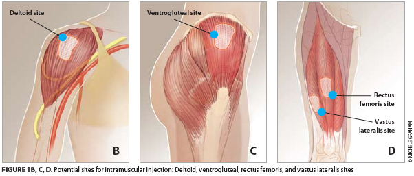 <p>1. deltoid ≤ 1 mL (less than 1 mL)</p><p><br></p><p>2. ventrogluteal > 1 mL (more than 1mL)</p><p><br></p><p>3. vastus lateralis (pediatrics)</p><table style="min-width: 100px;"><colgroup><col style="min-width: 25px;"><col style="min-width: 25px;"><col style="min-width: 25px;"><col style="min-width: 25px;"></colgroup><tbody><tr><td colspan="1" rowspan="1" style="border: 1px solid rgb(196, 199, 197); padding: 8px 12px;"><p><strong>Injection type</strong></p></td><td colspan="1" rowspan="1" style="border: 1px solid rgb(196, 199, 197); padding: 8px 12px;"><p><strong>Needle Gauge & Length</strong></p></td><td colspan="1" rowspan="1" style="border: 1px solid rgb(196, 199, 197); padding: 8px 12px;"><p><strong>Angle</strong></p></td><td colspan="1" rowspan="1" style="border: 1px solid rgb(196, 199, 197); padding: 8px 12px;"><p><strong>Location</strong></p></td></tr><tr><td colspan="1" rowspan="1" style="border: 1px solid rgb(196, 199, 197); padding: 8px 12px;"><p><span><strong>Intramuscular (IM)</strong></span></p></td><td colspan="1" rowspan="1" style="border: 1px solid rgb(196, 199, 197); padding: 8px 12px;"><p><span>20-23 G x 1-3"</span></p></td><td colspan="1" rowspan="1" style="border: 1px solid rgb(196, 199, 197); padding: 8px 12px;"><p><span>90°</span></p></td><td colspan="1" rowspan="1" style="border: 1px solid rgb(196, 199, 197); padding: 8px 12px;"><p>1. deltoid ≤ 1 mL</p><p><br></p><p>2. ventrogluteal > 1 mL</p><p><br></p><p>3. vastus lateralis (pediatrics)</p></td></tr><tr><td colspan="1" rowspan="1" style="border: 1px solid rgb(196, 199, 197); padding: 8px 12px;"><p><span><strong>Subcutaneous (SC)</strong></span></p></td><td colspan="1" rowspan="1" style="border: 1px solid rgb(196, 199, 197); padding: 8px 12px;"><p><span>25-26 G x 5/8"</span></p></td><td colspan="1" rowspan="1" style="border: 1px solid rgb(196, 199, 197); padding: 8px 12px;"><p><span>45°</span></p></td><td colspan="1" rowspan="1" style="border: 1px solid rgb(196, 199, 197); padding: 8px 12px;"><p>1. lower abdomen</p><p><br></p><p>2. fatty part of upper arm</p><p><br></p><p>3. outer thigh</p></td></tr><tr><td colspan="1" rowspan="1" style="border: 1px solid rgb(196, 199, 197); padding: 8px 12px;"><p><span><strong>Insulin (SC)</strong></span></p></td><td colspan="1" rowspan="1" style="border: 1px solid rgb(196, 199, 197); padding: 8px 12px;"><p><span>31 G x 1/4"</span></p></td><td colspan="1" rowspan="1" style="border: 1px solid rgb(196, 199, 197); padding: 8px 12px;"><p><span>90°</span></p></td><td colspan="1" rowspan="1" style="border: 1px solid rgb(196, 199, 197); padding: 8px 12px;"><p><span><em>(Locations shared with Subcutaneous above)</em></span></p></td></tr><tr><td colspan="1" rowspan="1" style="border: 1px solid rgb(196, 199, 197); padding: 8px 12px;"><p><span><strong>Intradermal (ID)</strong></span></p></td><td colspan="1" rowspan="1" style="border: 1px solid rgb(196, 199, 197); padding: 8px 12px;"><p><span>27-28 G x 3/8</span></p></td><td colspan="1" rowspan="1" style="border: 1px solid rgb(196, 199, 197); padding: 8px 12px;"><p><span>5-15°</span></p></td><td colspan="1" rowspan="1" style="border: 1px solid rgb(196, 199, 197); padding: 8px 12px;"><p>1. mid forearm (PPD testing)</p><p><br></p><p>2. back (allergy testing)</p></td></tr></tbody></table><p></p>