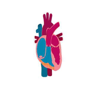 <p>Fibrofatty replacement of RV tissue resulting in wall thinning and aneurysm formation</p><p>RV dilatation and dysfunction</p>