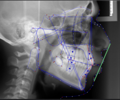 <p>which reference plane:</p><p>- Tip of Nose to Soft Tissue Pogonion</p><p>- Lip protrusion reference plane</p><p>- Heavily affected by nose and chin size</p>