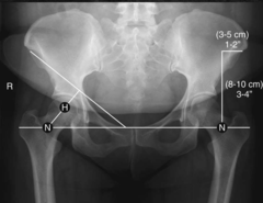 <p>How do you find the the neck of the femur?</p>