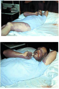 <p>Questions</p><ol><li><p>What is the position of the body at the time of death based on the findings?</p></li><li><p>What evidence supports the conclusion that the body was moved after livor mortis had fixed?</p></li></ol><div data-type="horizontalRule"><hr></div><p></p>